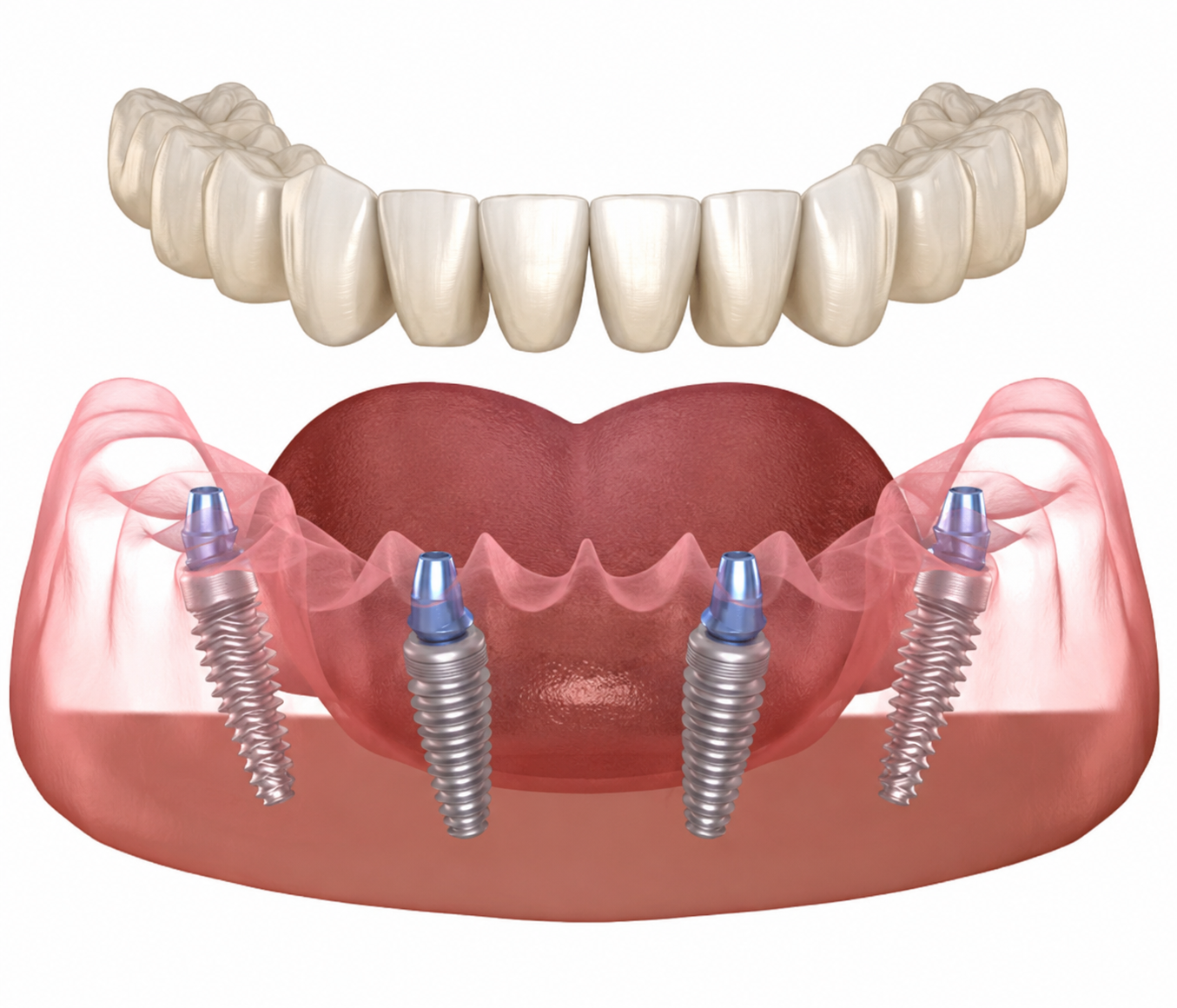 Full-arch implant illustration