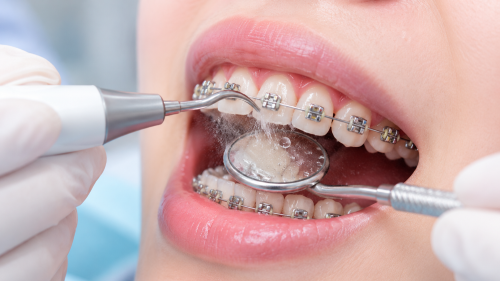 Seongnam orthodontic dental clinic scaling during braces AI image