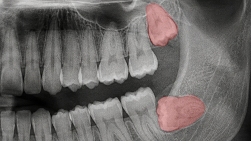 Moran Station dental clinic wisdom tooth panorama AI image