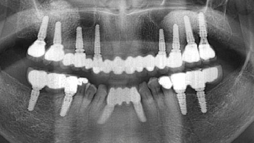 Moran Station Dental Clinic Implant Placement Panoramic AI Image