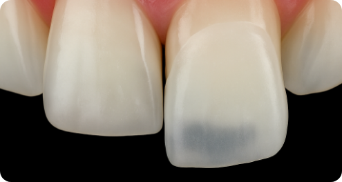 치아 황금 비율을 찾는 더서울치과의원 라미네이트