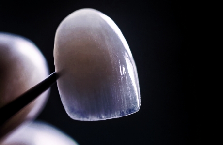 강도와 뷰티를 모두 잡은 리튬 다이 실리케이트 블럭