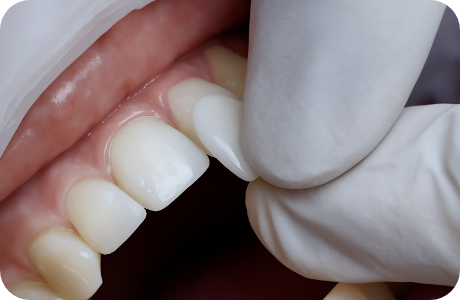 2차 보완 및 완성된 보철 세팅