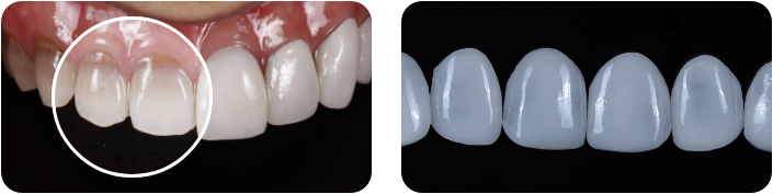 강도와 재질까지 잡은 보철물